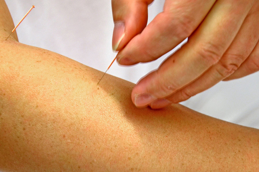 Foto von Hand an Akupunkturnadel beim Einstechen der Nadel in die Haut