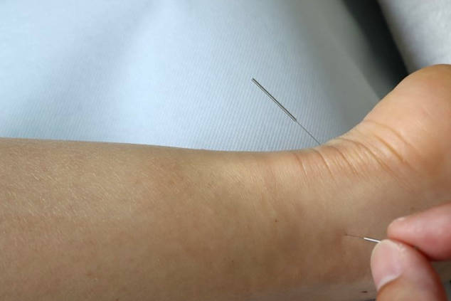 Akupunktur Symbolbild: Foto einer Hand, die Akupunkturnadeln am Fussgelenk setzt.